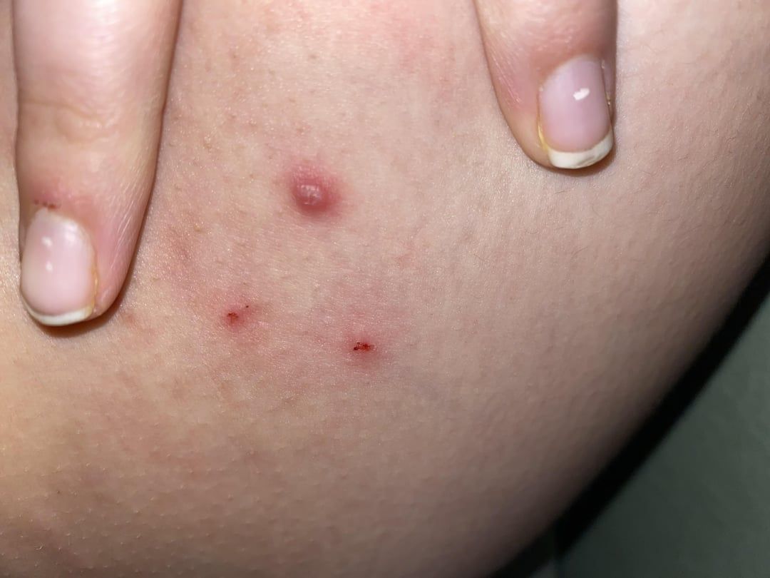 Complete Guide to Warts Removal Surgery