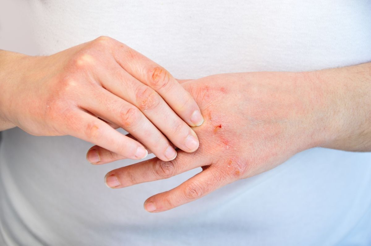 Contact Dermatitis Market Key Players & Forecast Report to 2028