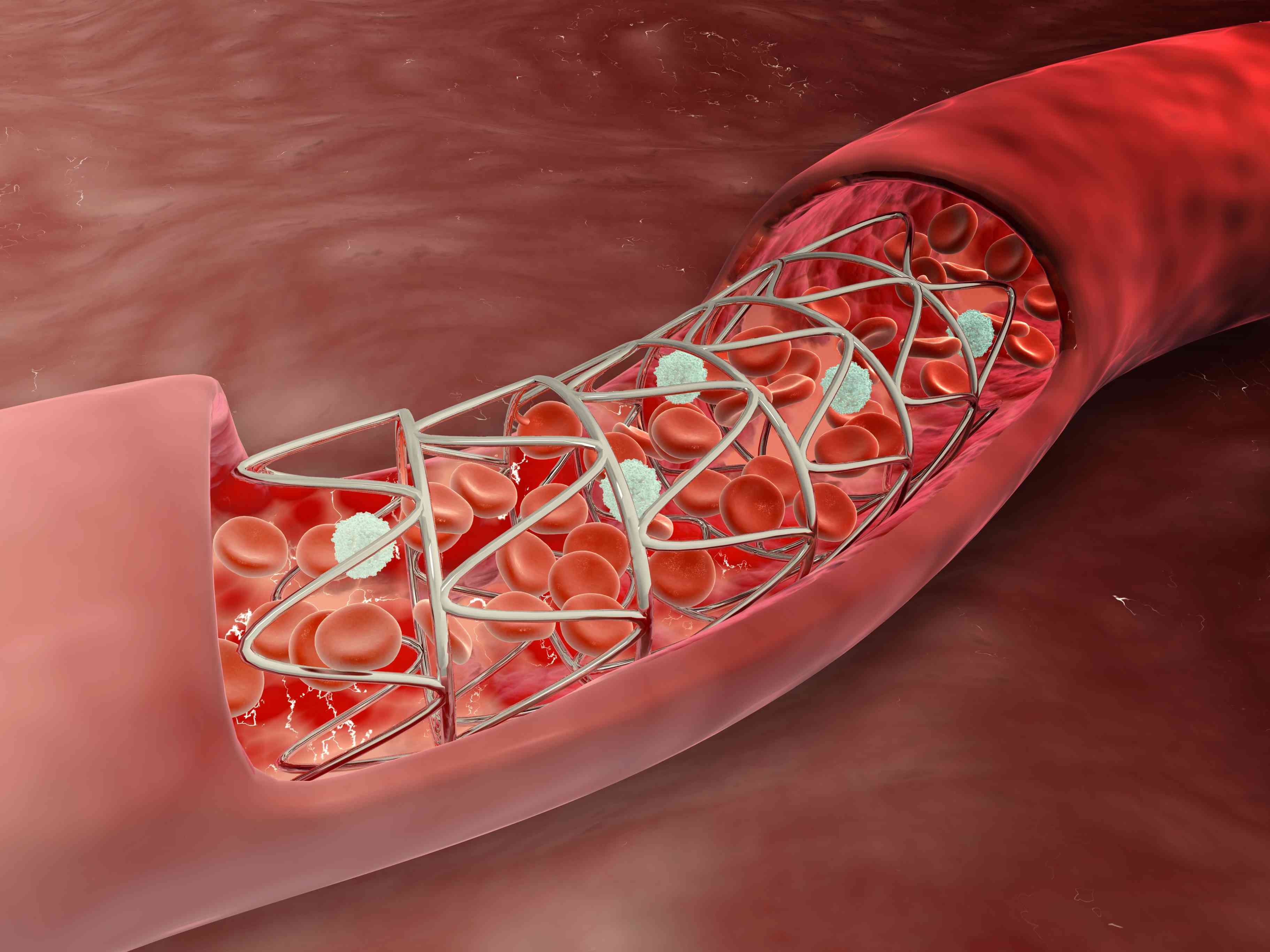 Coronary Arteries Stent Market Size, Analysis & Forecast to 2028
