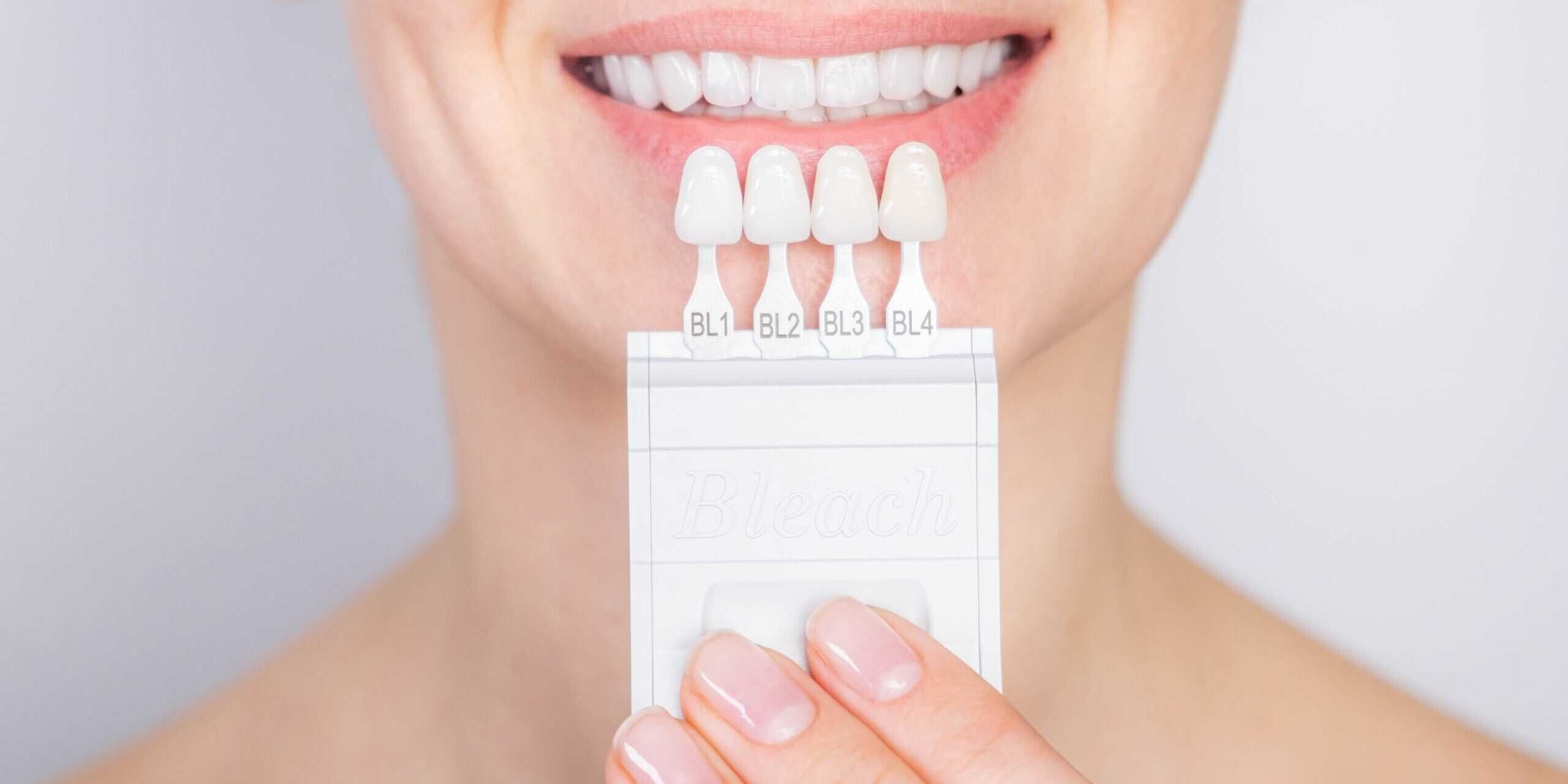 Cost of Dental Veneers Differs from Traditional Braces