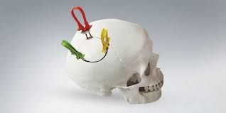 Cranial Fixation and Stabilization Systems Market Analysis Report