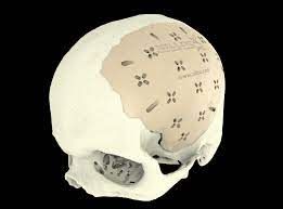 Cranial Implants Treatment Market Report 2022 With Analysis 