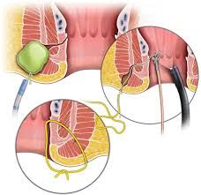 Crohn’s Disease Treatment Market Size, Report 2022-2028
