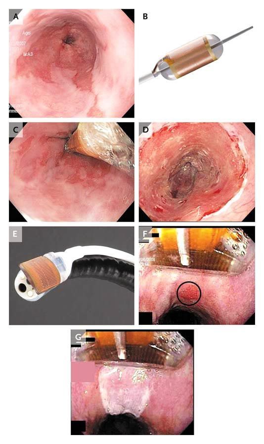 Cryoballoon Ablation System Market 2022 Growth Factors Forecast 