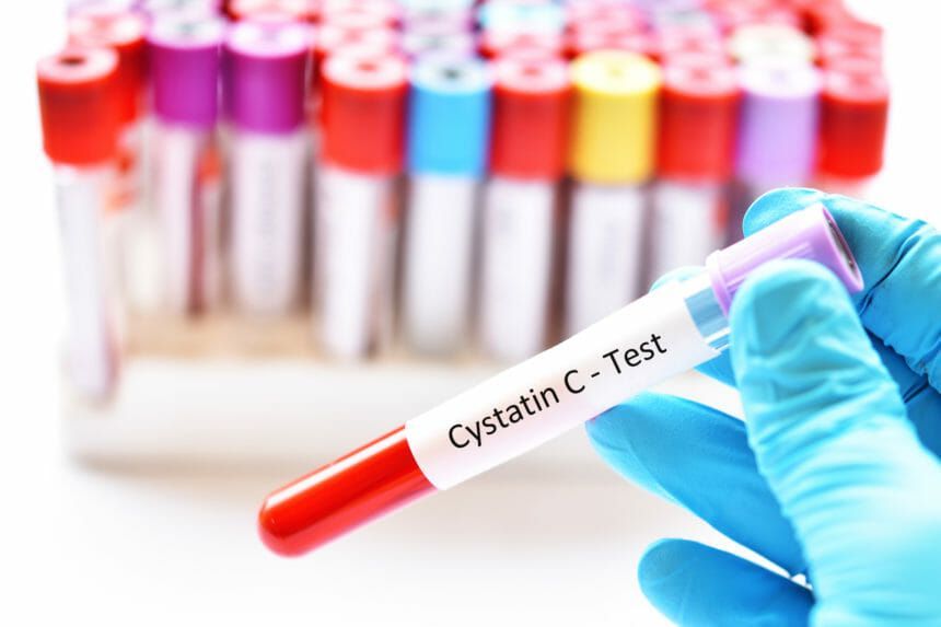 Global Cystatin C Testing Market Research 2030