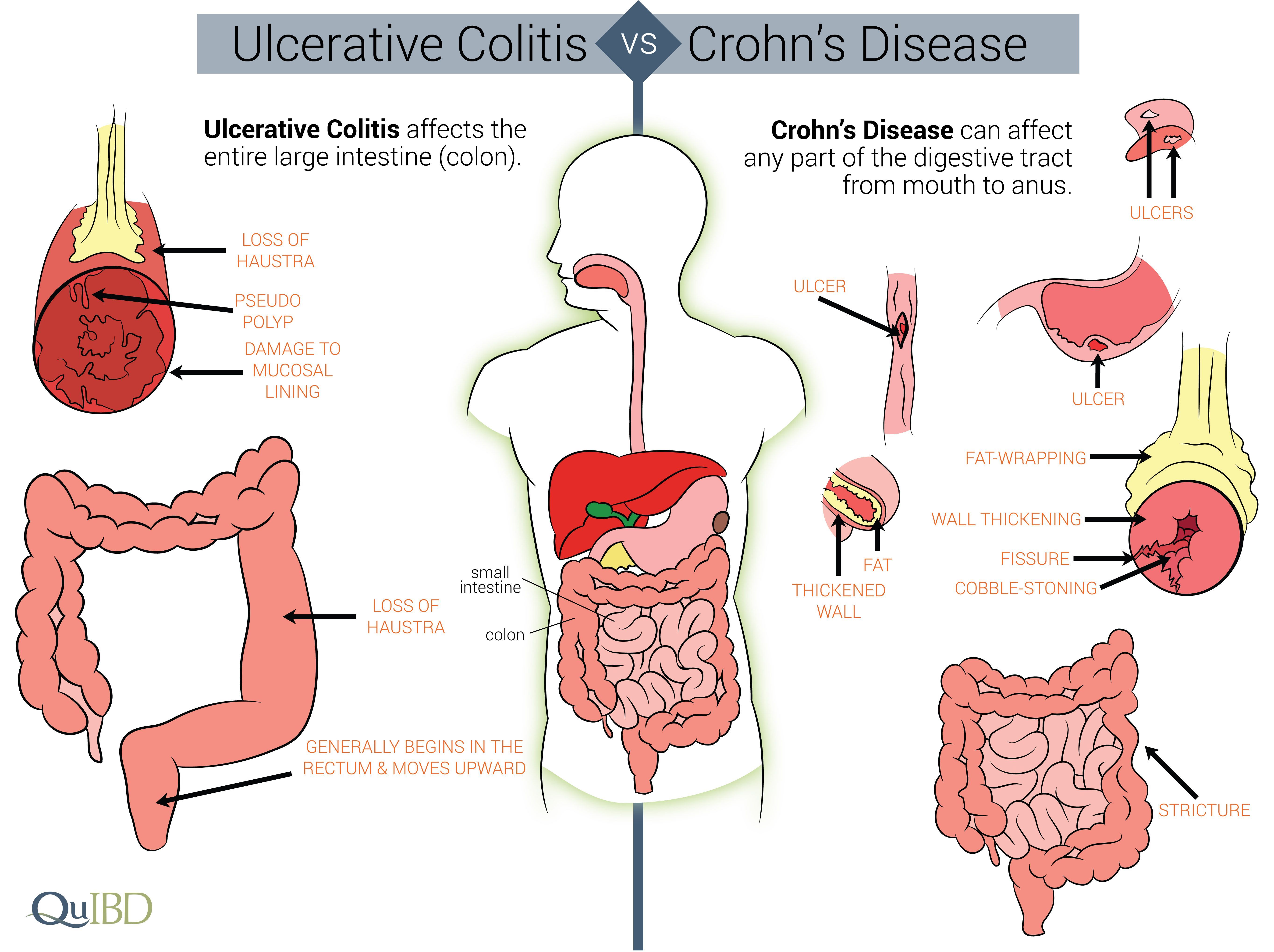 Ibd (Ulcerative Colitis and Crohn's Disease) Treatment Market