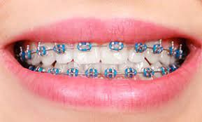 Braces Cost Over the Years in Pakistan: A Look at Then vs. Now