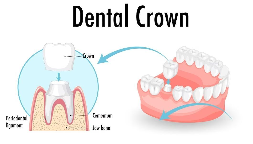 5 Benefits of Dental Crowns: Enhancing Strength and Aesthetics