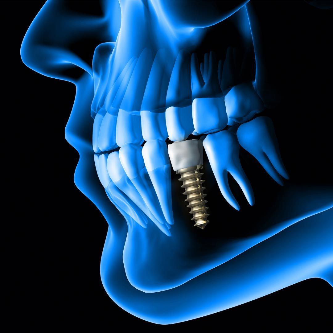 How to Find an Affordable Dental Implant Clinic in Dubai