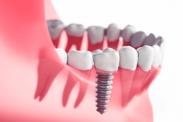 Dental implants Precision Crafted Solution For Missing Teeth Restoration