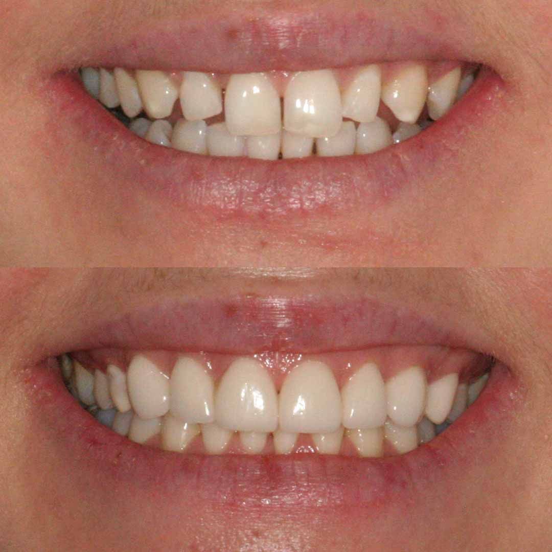 Dental Veneers Cost: Get the Smile You Deserve