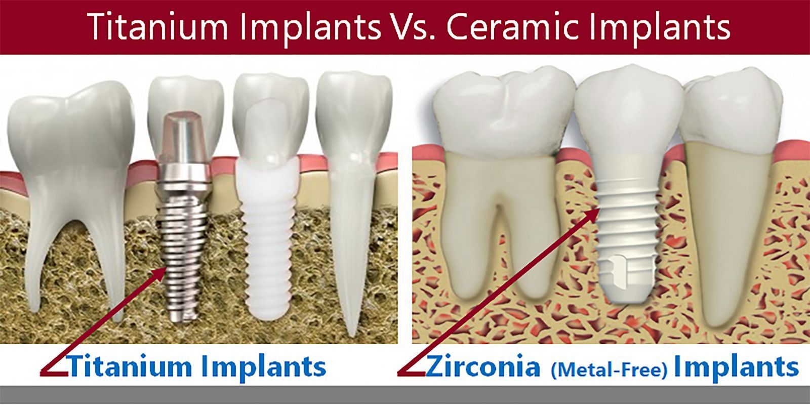 Dental Zirconia Implant Market Opportunity & Forecast to 2028

