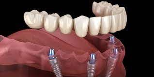 The Ultimate Guide to Finding the Best Dentist in Belmont