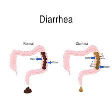 Diarrhea Market Size, Status, Growth | Industry Analysis Report