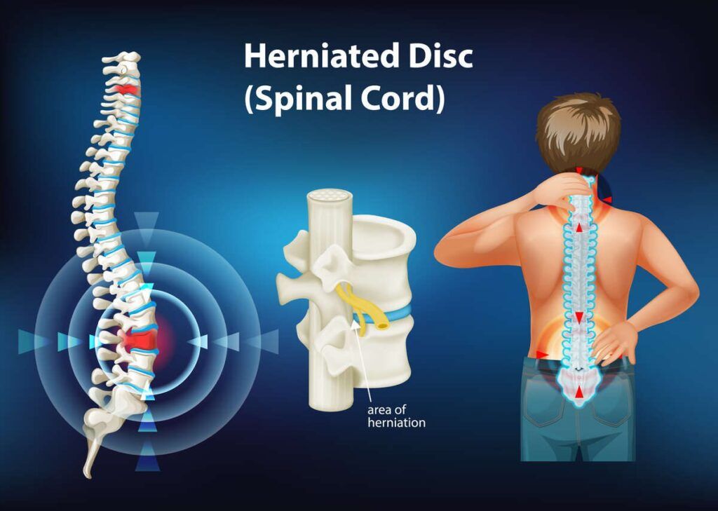 Disc Problem Symptoms Explained – Expert Neurology & Spine Care
