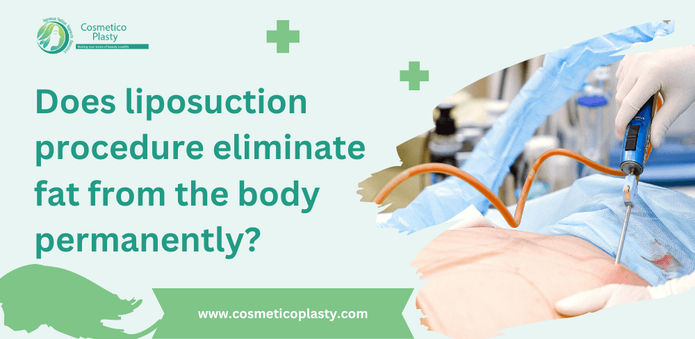 Does Liposuction Procedure Eliminate Fat From Body Permanently?