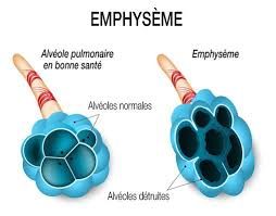 Emphysema Treatment Market Report  Benchmarking
