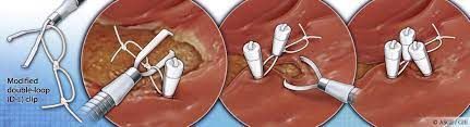 Endoscopic Clip Market 2022 Major Key Players & Industry Analysis