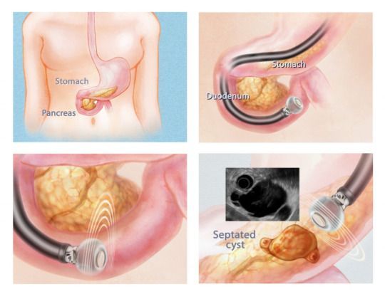 Endoscopic Ultrasound Market Overview 2021–2028