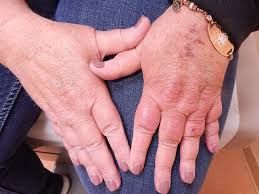 Erythromelalgia Treatment Market Opportunity & Forecast to 2028
