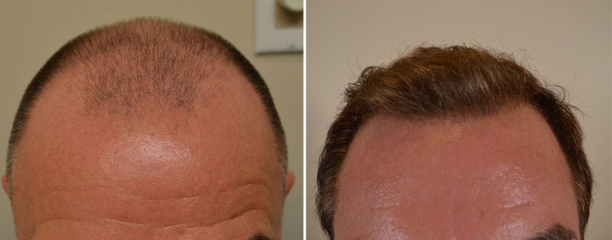 FUE Hair Transplant in Dubai for Receding Hairline
