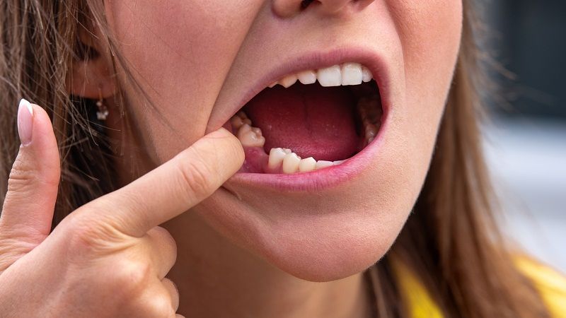 Oral Hygiene After Tooth Extraction