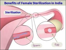 Female Sterilization Procedures Market Report 
