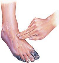 Gangrene Treatment Market Size, Share - Industry Report 2028