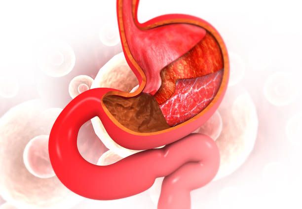 Safe Gastric Balloon in Riyadh: Expert Weight Loss Help