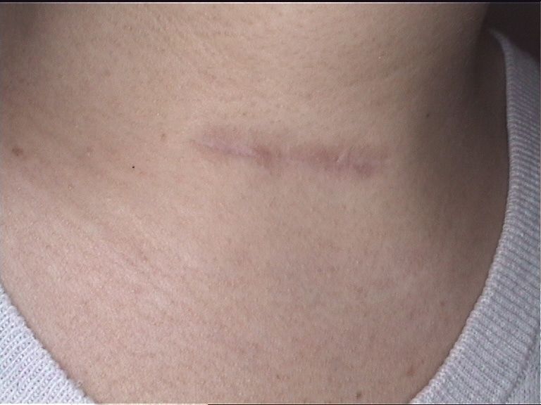 Get Smooth Skin with Professional Surgical Scar Revision