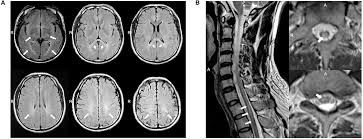 Globoid Cell Leukodystrophy Market Opportunity, Growth Analysis