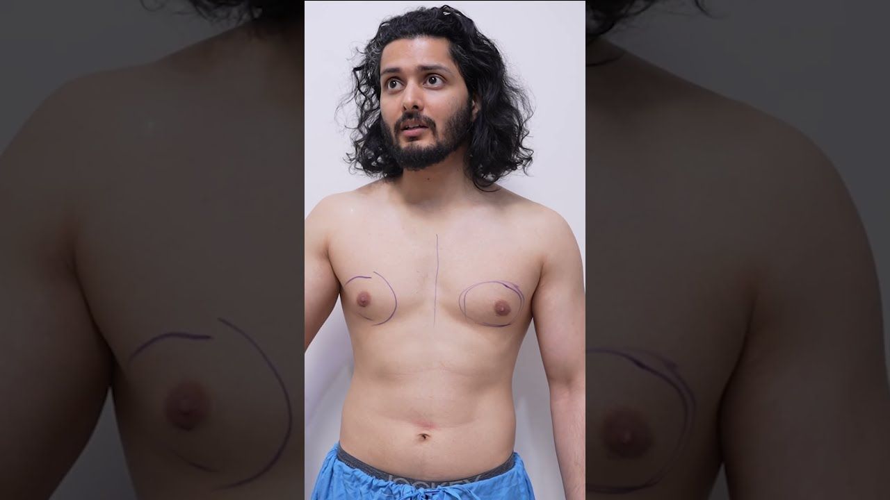 Gynaecomastia Surgery in Dubai for Male Fitness Look