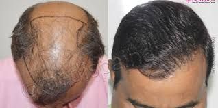 Hair Transplant Cost in Dubai: Steps to Determine the Best Option for You! 🌟