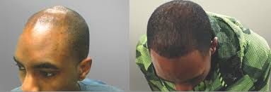 What Is the Best Non Surgical Hair Replacement for Men?