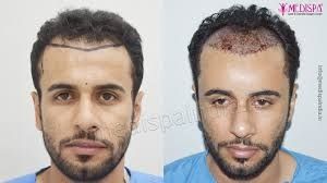 Get the Best Value for Hair Transplants in Dubai