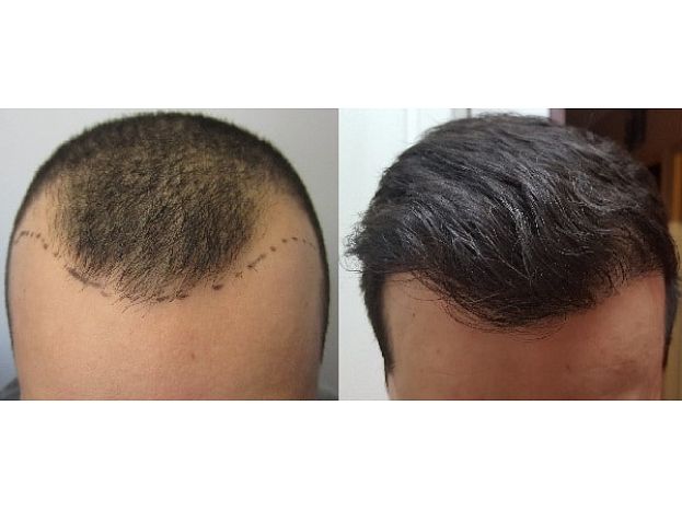 Hair Transplant in Dubai Hair Loss Causes and Solutions