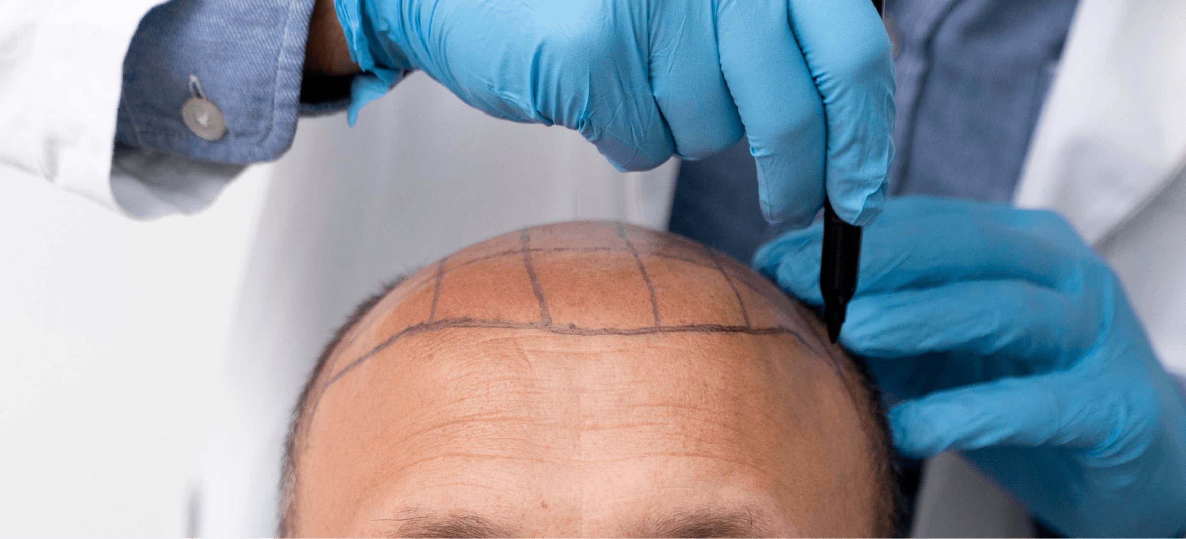 Book Your Hair Transplant in Islamabad: What to Expect Step-by-Step