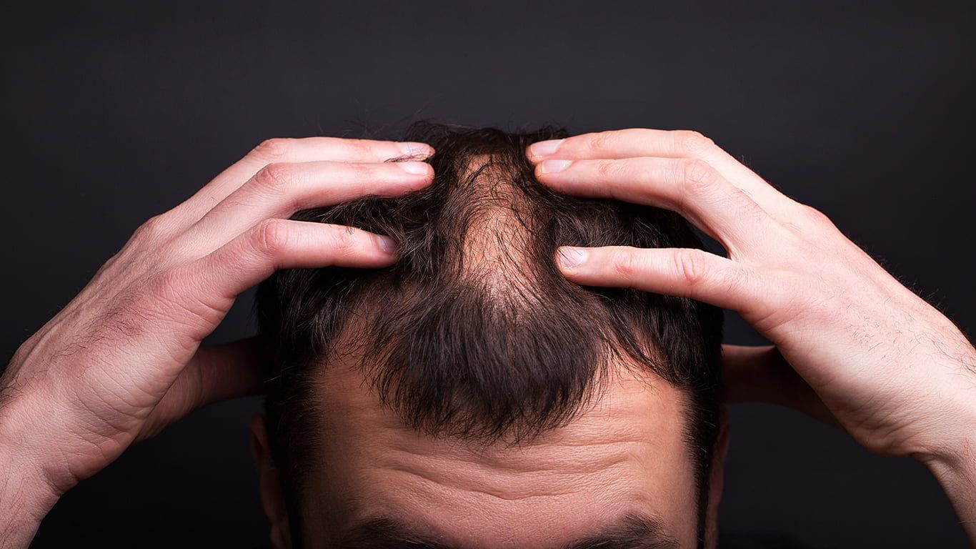 Hair Loss Treatment in Islamabad Pakistan