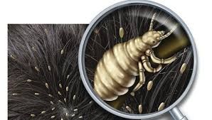 Head Lice Infestation Treatment Market Forecast to 2028
