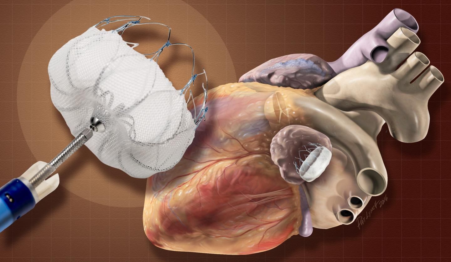 Heart Closure Devices Market 2022: Covid-19 Impact Analysis 2028
