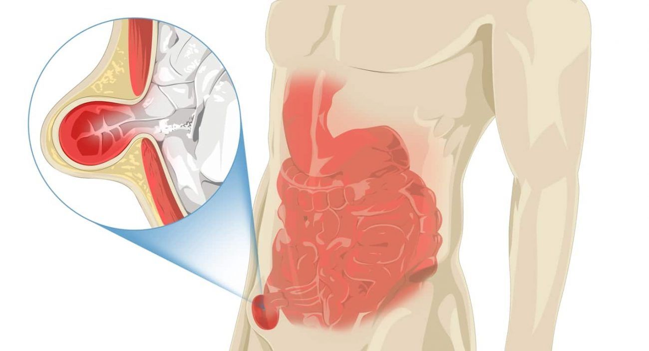 Laparoscopic Groin or Inguinal Hernia Repair