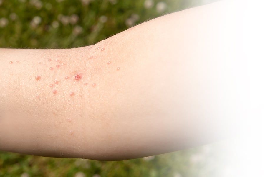 How to Use Salicylic Acid to Help Remove Warts Safely