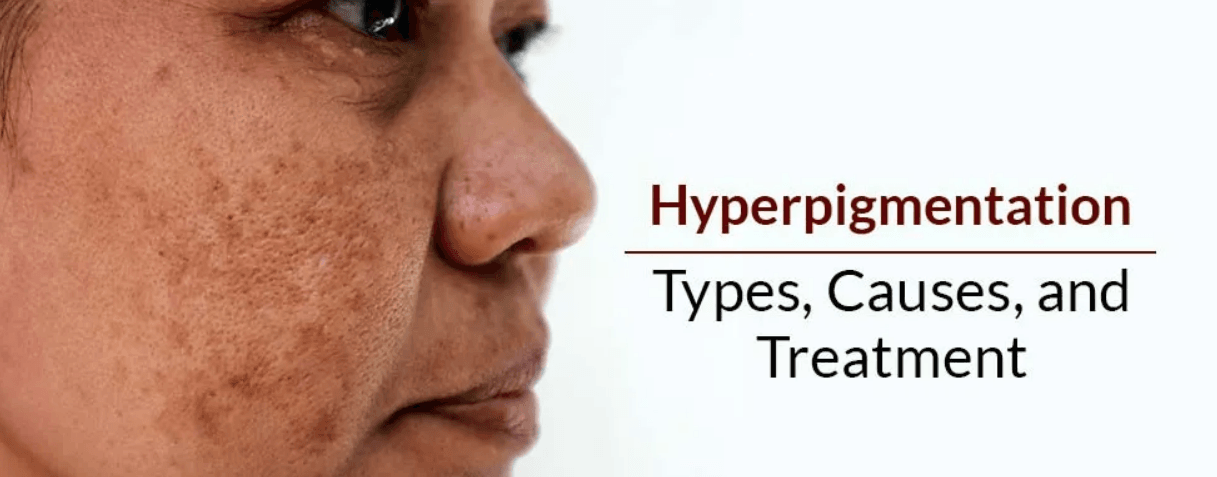 Hyperpigmentation Disorder Treatment Market 2022 Growth Factors 