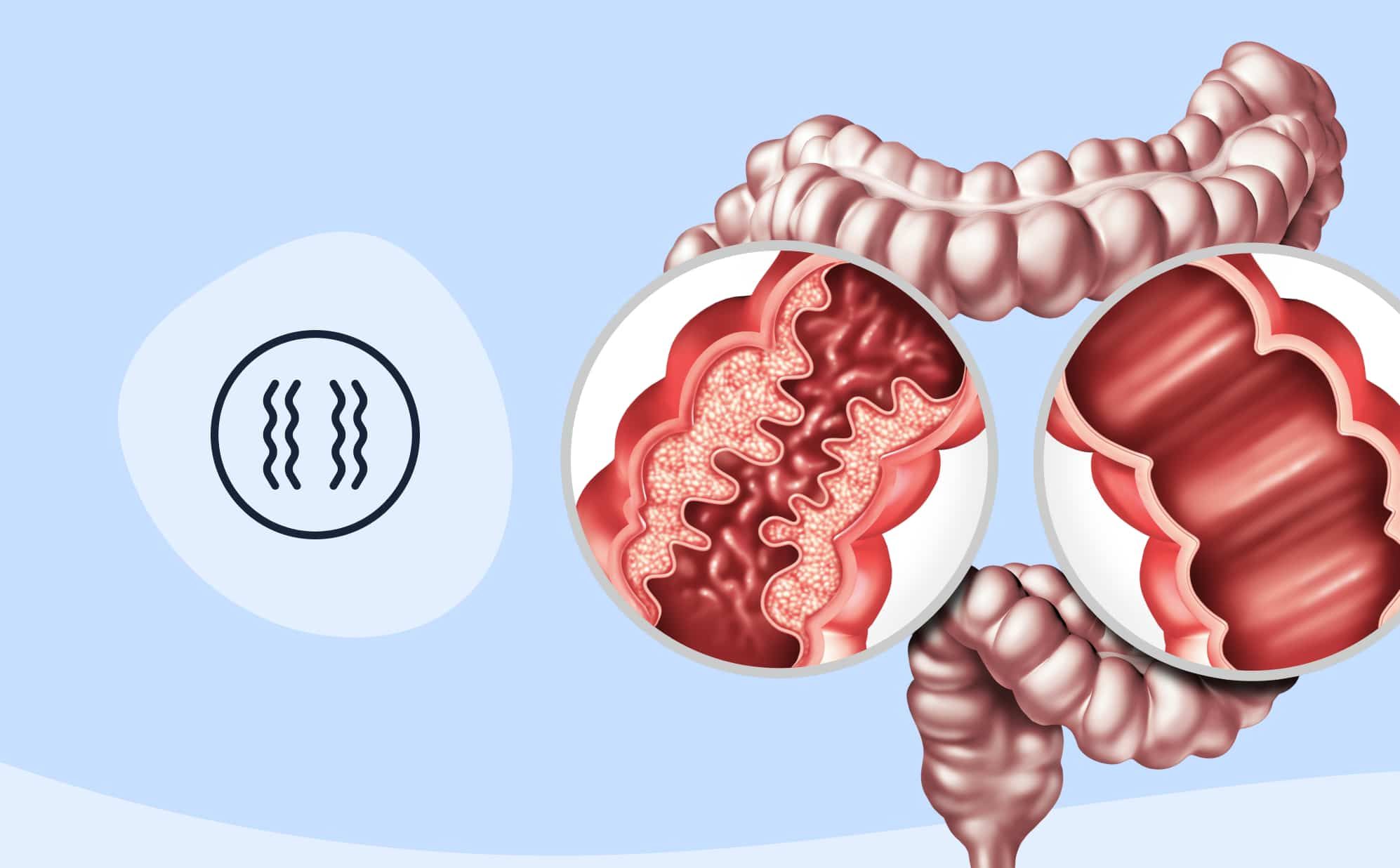 Irritable Bowel Syndrome: Symptoms, Triggers, and Management