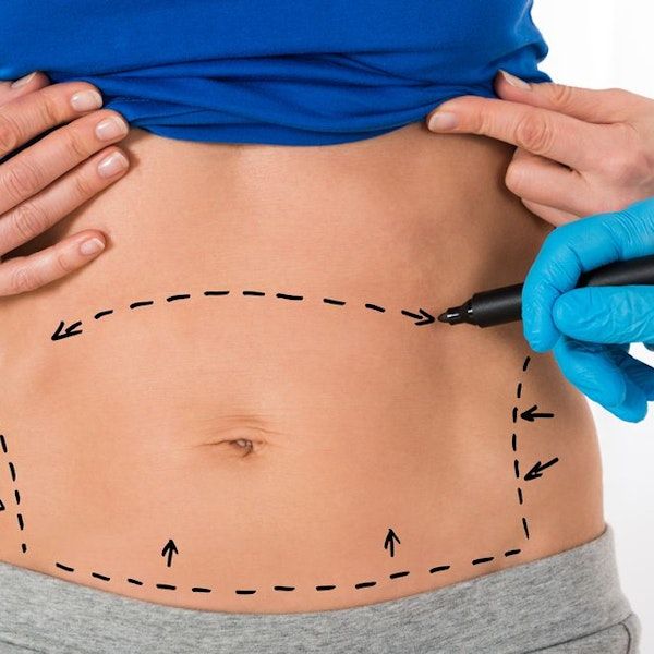 Improve Body Definition with Laser Liposuction