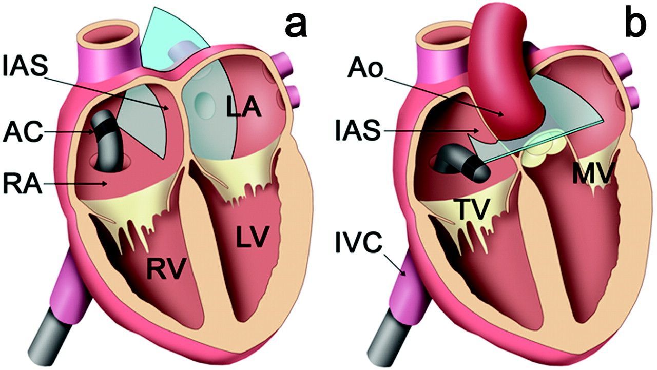 Intracardiac Echocardiography & Intravascular Ultrasound Market
