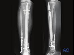 Intramedullary Nail Market Size, Share, Forecast to 2028