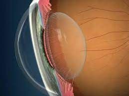 Intraocular Lens Market Size, Regional Overview and Forecast