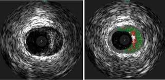 Intravascular Ultrasound Market Opportunity & Forecast to 2028
