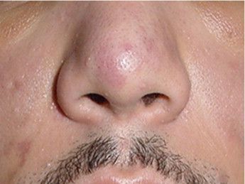Global Kaposi Sarcoma Market Size, Share, Development Report
